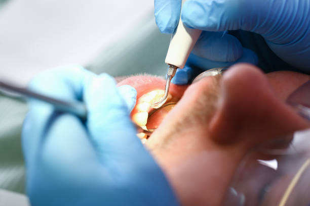 Best Emergency Wisdom Teeth Removal in Keene, NH